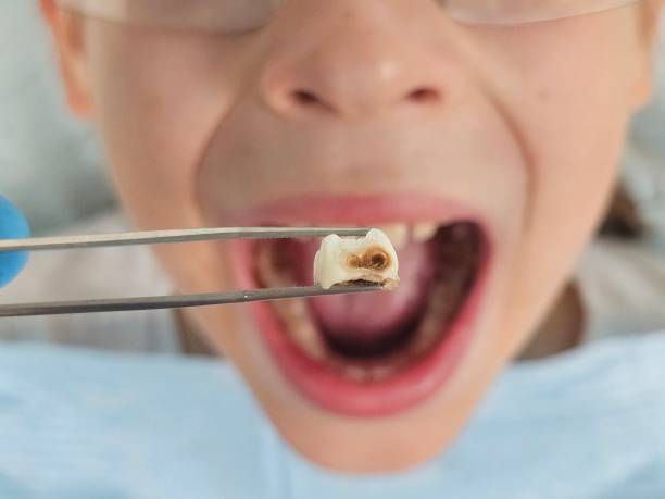 Best Emergency Tooth Extraction  in Gwinn, MI
